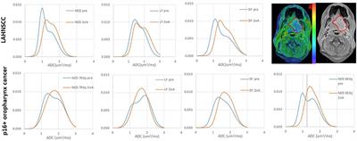 Diffusion MRI correlation with p16 status and prediction for tumor progression in locally advanced head and neck cancer